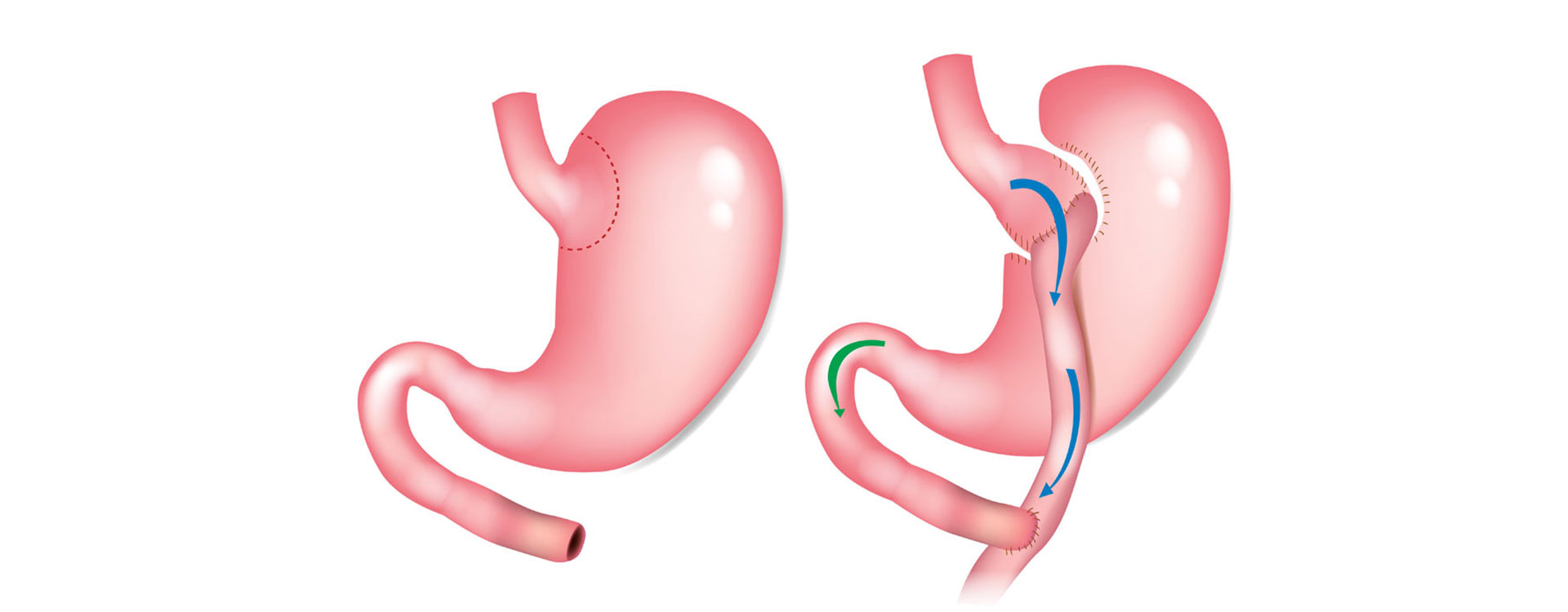 Gastric Bypass