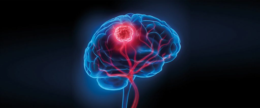 Beyin Tümör