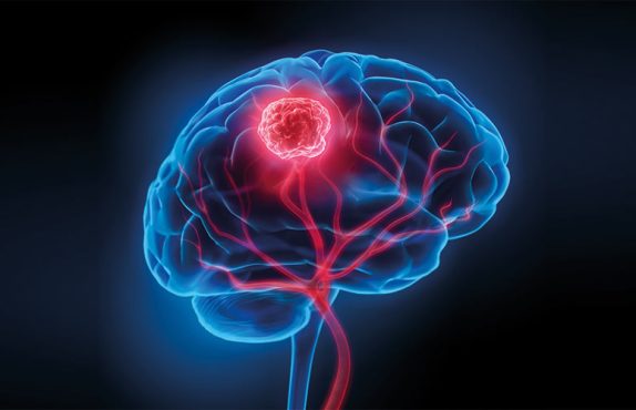 beyin-tumor Beyin Tümör