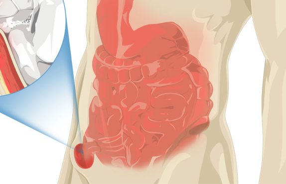 Kasık Fıtığı nedir?