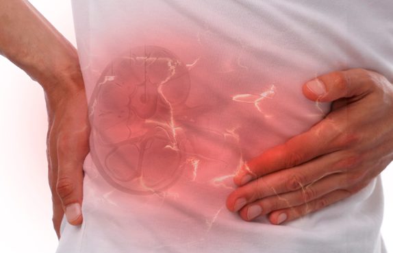 Böbrek Taşları Hakkında A’dan Z’ye Herşey
