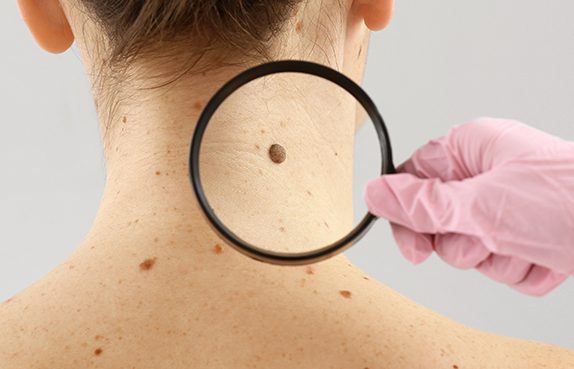 Benler ve Türleri-blog-crlu