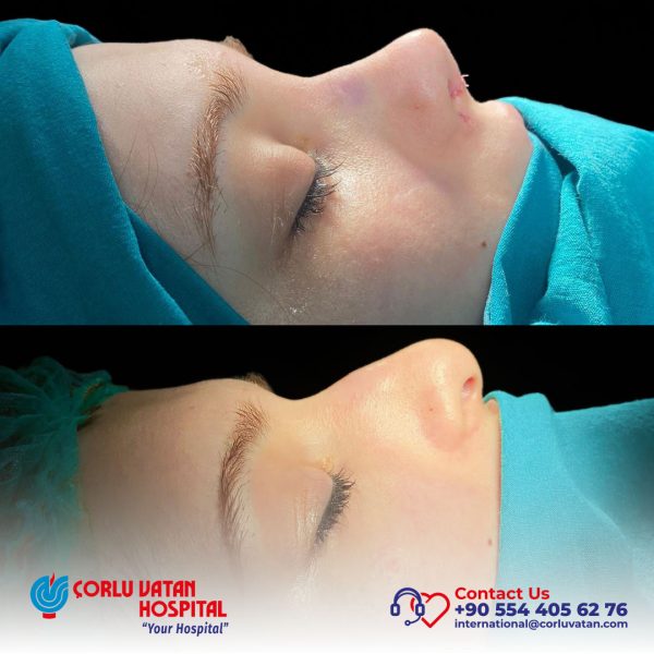 rinoplasti_oncesisonrasi_eng_02052024-14