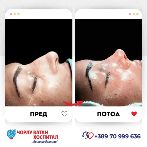 01_rinoplasti_mikrositesi_05062024mk