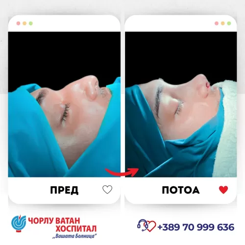 02_rinoplasti_mikrositesi_05062024mk