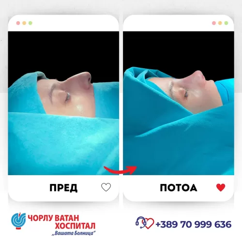 03_rinoplasti_mikrositesi_05062024mk