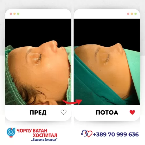 04_rinoplasti_mikrositesi_05062024mk