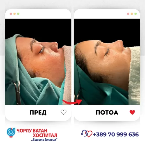 05_rinoplasti_mikrositesi_05062024mk