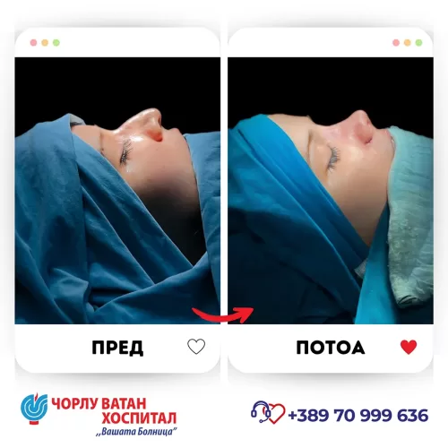 06_rinoplasti_mikrositesi_05062024mk