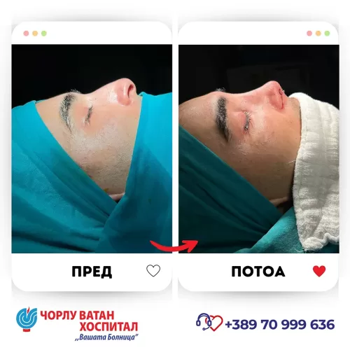 07_rinoplasti_mikrositesi_05062024mk