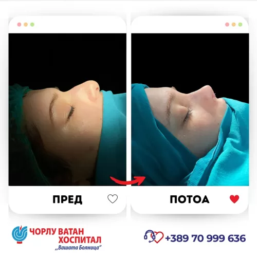 08_rinoplasti_mikrositesi_05062024mk