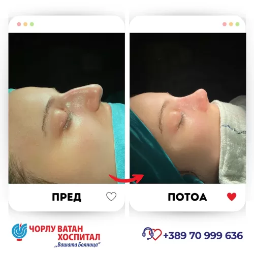 09_rinoplasti_mikrositesi_05062024mk