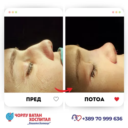 10_rinoplasti_mikrositesi_05062024mk