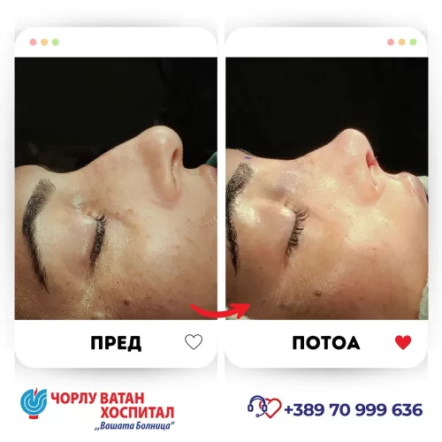 11_rinoplasti_mikrositesi_05062024mk