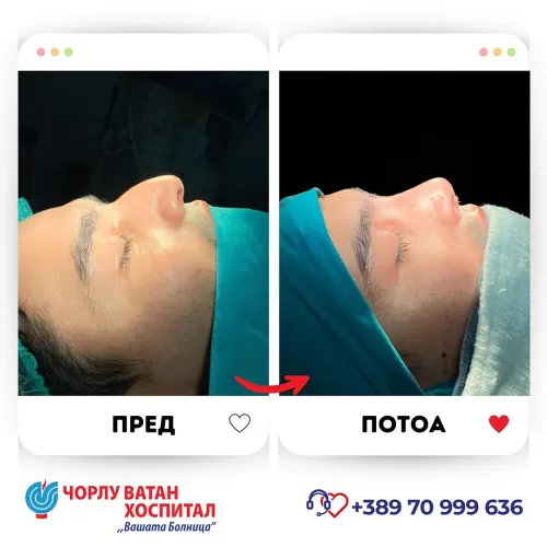 12_rinoplasti_mikrositesi_05062024mk