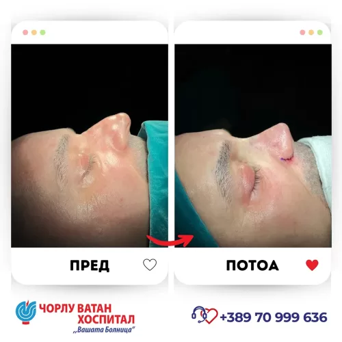 13_rinoplasti_mikrositesi_05062024mk