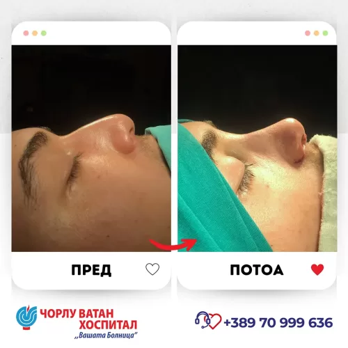 14_rinoplasti_mikrositesi_05062024mk