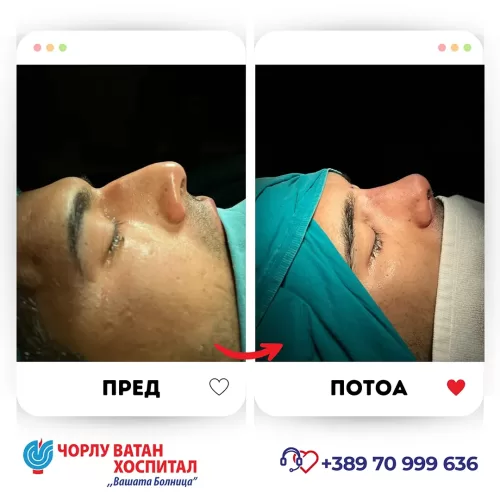 15_rinoplasti_mikrositesi_05062024mk