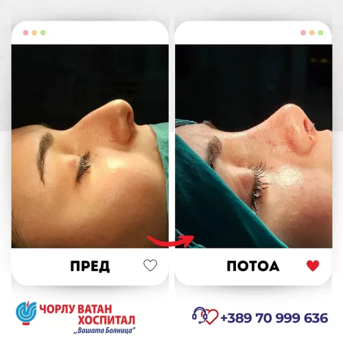 16_rinoplasti_mikrositesi_05062024mk