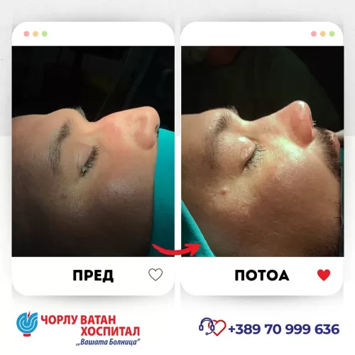 17_rinoplasti_mikrositesi_05062024mk