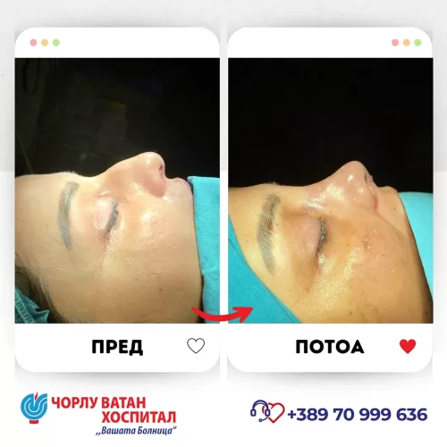 18_rinoplasti_mikrositesi_05062024mk