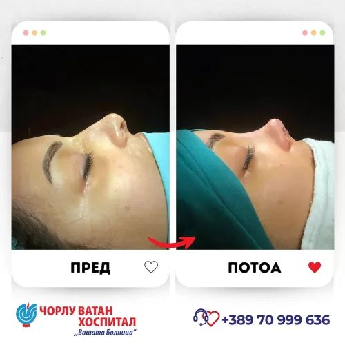 19_rinoplasti_mikrositesi_05062024mk