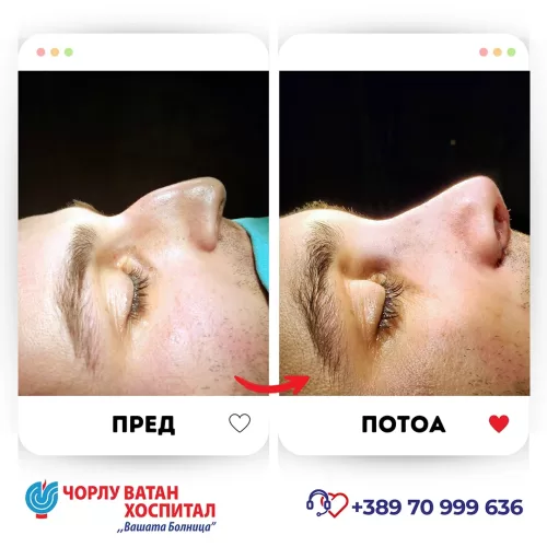 20_rinoplasti_mikrositesi_05062024mk