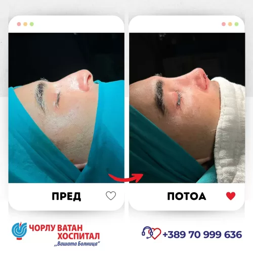 21_rinoplasti_mikrositesi_05062024mk