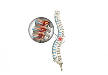 Vidasız-Dar-Kanal-Ameliyatı-Nedir-10122024