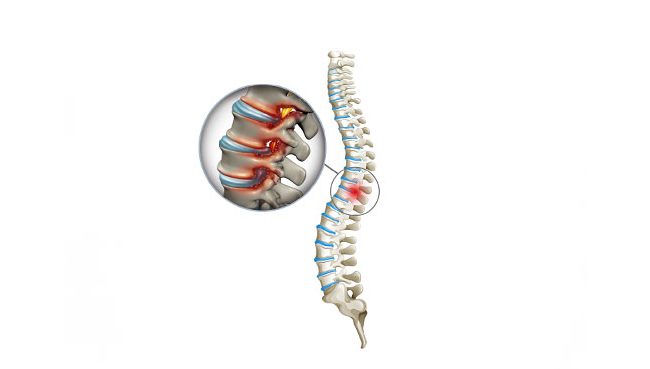 Vidasız-Dar-Kanal-Ameliyatı-Nedir-10122024