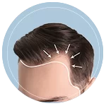 hair-transplant-06052025 hair-transplant-06052025