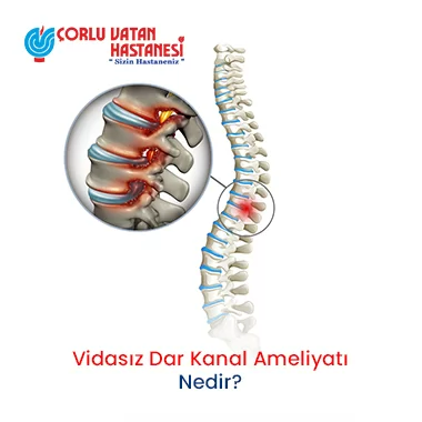 VİDASIZ DAR KANAL AMELİYATI NEDİR?