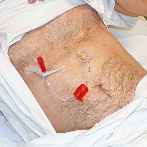 Evde Peg Bakımı (Beslenme)