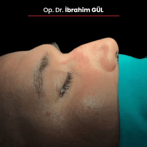 Öncesi Sonrası 218622302