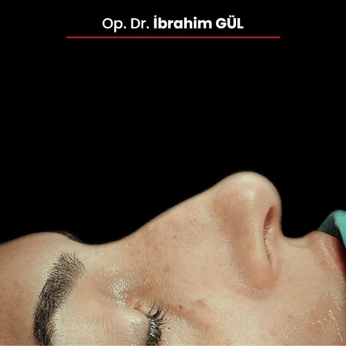 Öncesi Sonrası 98152837