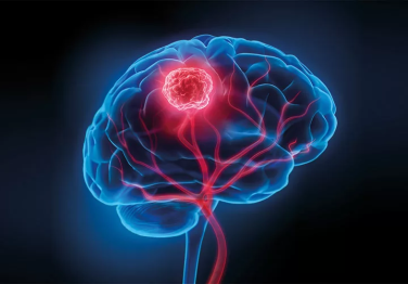 Beyin Tümörü Belirtileri ve Tedavisi