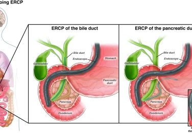 Safra Yolları ve Pankreas Kanalındaki Hastalıkların Tedavisinde ERCP Yöntemi