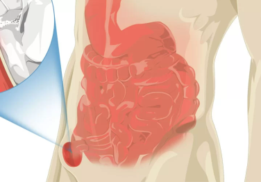 Kasık Fıtığı Nedir?