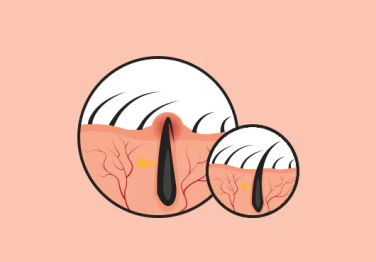 Basur, Fistül ve Kıl Dönmesi Tedavisinde Lazer Teknolojisi