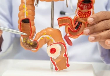 Kolorektal Kanseri Farkındalığı: Belirtileri ve Tarama Yöntemleri