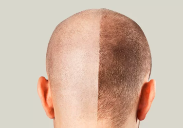 Saç Ekimi Nasıl Yapılır? Nelere Dikkat Edilmeli?