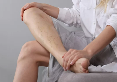 Ameliyatsız Varis Tedavisi