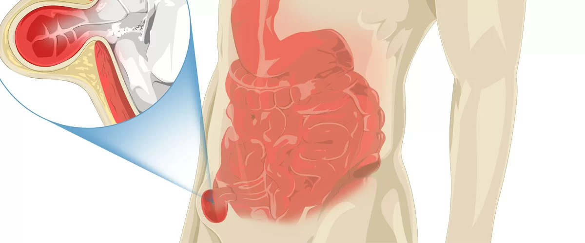 Kasık Fıtığı Nedir?