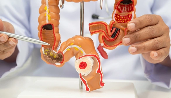 Kolorektal Kanseri Farkındalığı: Belirtileri ve Tarama Yöntemleri