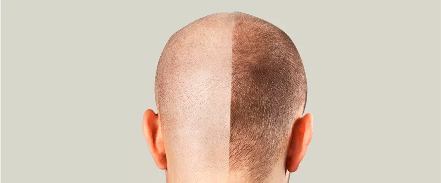 Saç Ekimi Nasıl Yapılır? Nelere Dikkat Edilmeli?