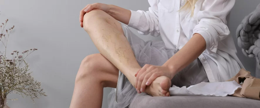 Ameliyatsız Varis Tedavisi