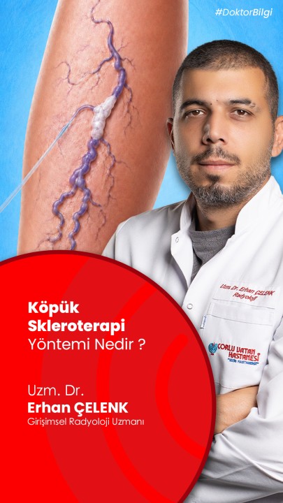 Varislerden kurtulmak için ameliyat şart mı?