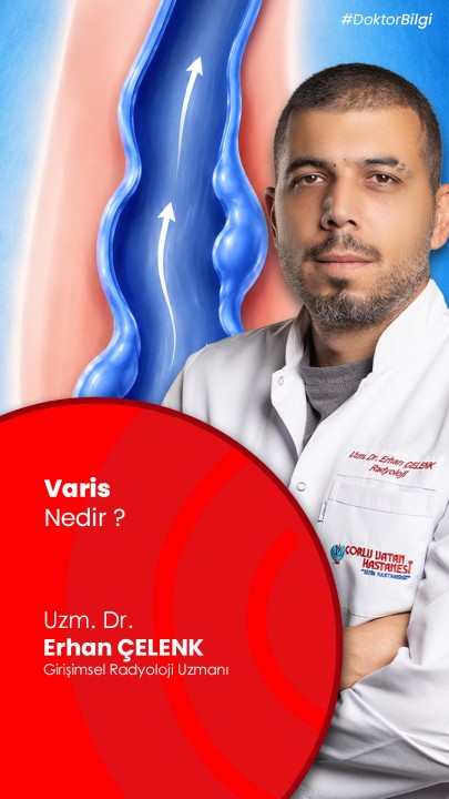 Bacaklarda Belirginleşen Damarlar Varis Belirtisi Olabilir mi?